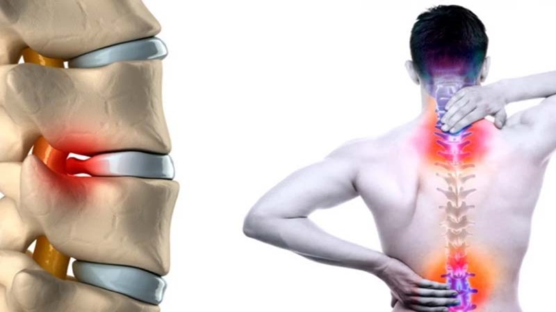 دیسک بین‌مهره‌ای | بهترین متخصص کایروپراکتیک اصفهان | دکتر مسعود اعتدالی