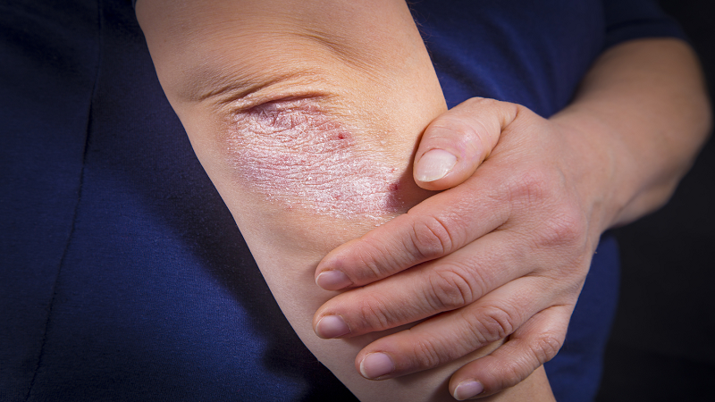 از بیماری التهاب مفاصل و پوست چه می دانید ؟ ( آرتریت پسوریاتیک )
