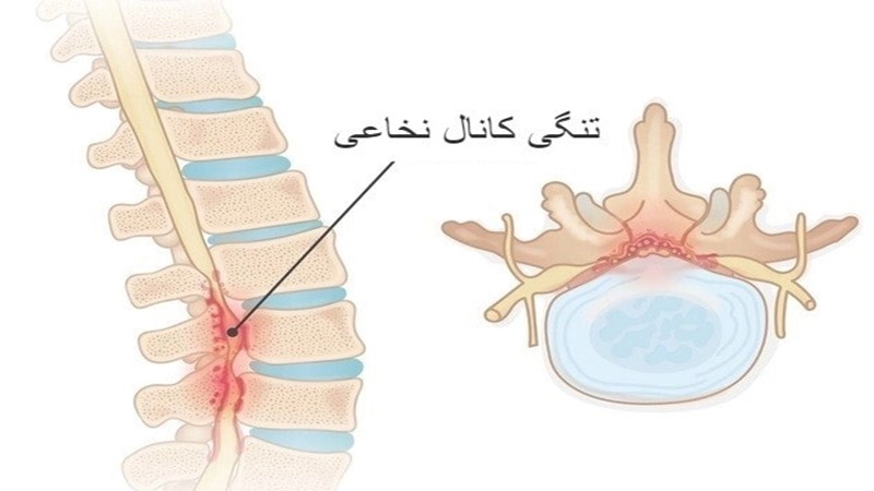 تنگی کانال نخاعی | بهترین متخصص کایروپراکتیک اصفهان | دکتر مسعود اعتدالی