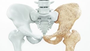 عوامل پوکی استخوان در افراد | بهترین متخصص کایروپراکتیک